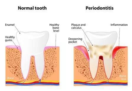 口腔问题会引发其它的疾病吗_口腔疾病会引发哪些疾病_口腔卫生会引起哪些疾病