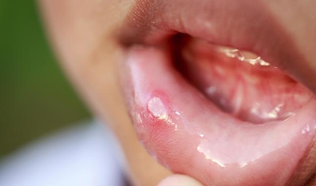 口腔溃疡总是长在同一个地方，可能是口腔癌吗？