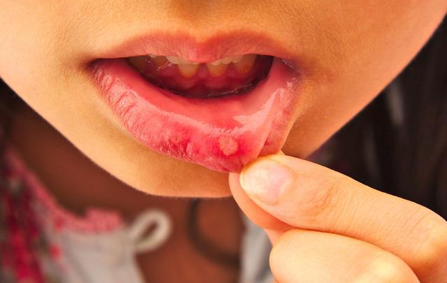 口腔溃疡总是长在同一个地方，可能是口腔癌吗？