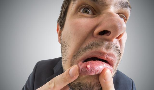 口腔溃疡疼痛难忍？5个方法快速治愈，屡试不爽！