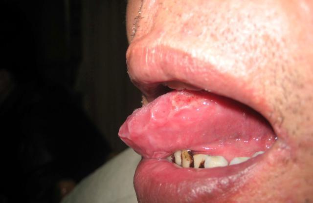 反复口腔溃疡、皮肤病，或许是这种”罕见病“，跟癌一样难缠