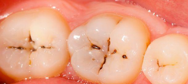 蛀牙从形成到失去牙齿需要多久？