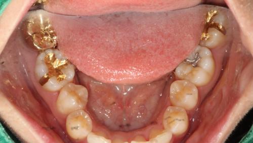 什么样的蛀牙该拔？不拔的蛀牙修复方式以及优缺点又有哪些？