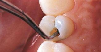 什么样的蛀牙该拔？不拔的蛀牙修复方式以及优缺点又有哪些？