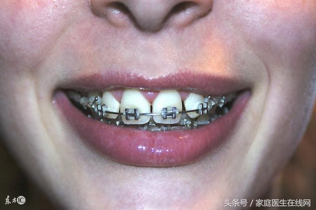 6类牙齿需尽快做牙齿矫正！不矫正丑一辈子！