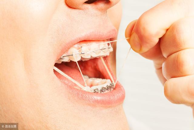 牙齿矫正前必须了解的4个问题，内含矫正过程中的护理细节！