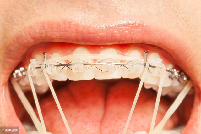 牙齿矫正前必须了解的4个问题，内含矫正过程中的护理细节！