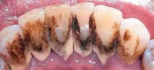 牙医眼中的洗牙竟然这么神奇，可以“包治口腔百病”