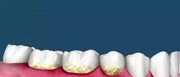 60多年没洗牙，牙科医生实拍最强牙石患者