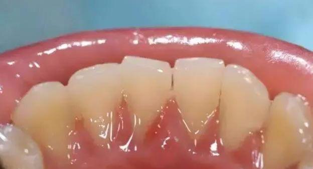 牙医眼中的洗牙竟然这么神奇，可以“包治口腔百病”