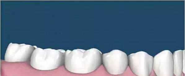 60多年没洗牙，牙科医生实拍最强牙石患者