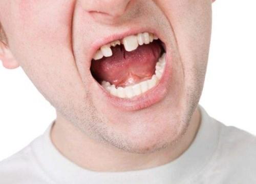 平均每个老人失牙约10颗！看了这，您就会知道该怎么选假牙！