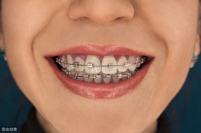 医生提醒：牙齿矫正期间，这几件事最好别做，否则就是白受罪