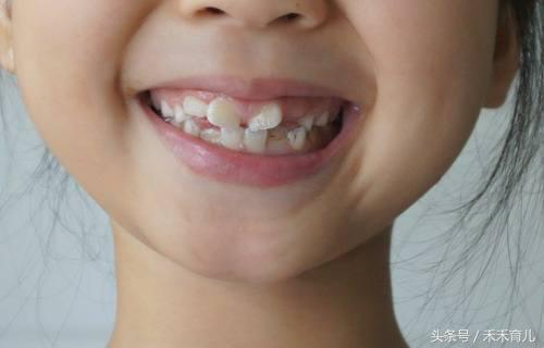 宝宝牙齿不齐的原因及危害，矫正牙齿的最佳年龄及费用