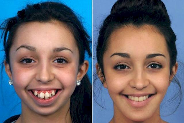 2年牙齿矫正经历分享,龅牙变整齐了,脸型却发生了这些变化!