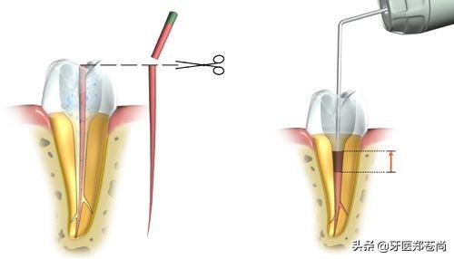 做了根管治疗的牙齿还能像以前一样用吗？会不会再出现什么问题？