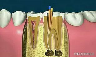 做了根管治疗的牙齿还能像以前一样用吗？会不会再出现什么问题？