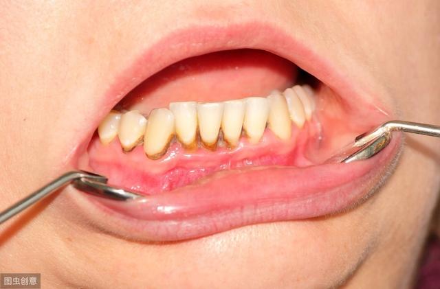 牙龈出血预示着非常危险的信号，你注意到了吗？