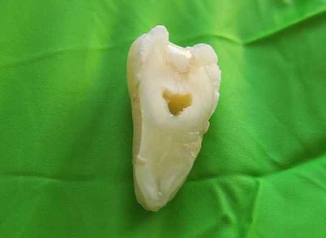 瑞典研究发现： 新型牙齿重建材料能够改善现有的以丙烯酸脂为基础的填充材料