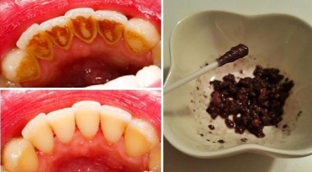 这些方法能美白牙齿，祛除口臭，连牙医都不知道！