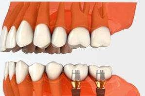 后牙缺失做种植牙如何？