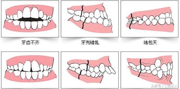 是什么导致了牙齿畸形？