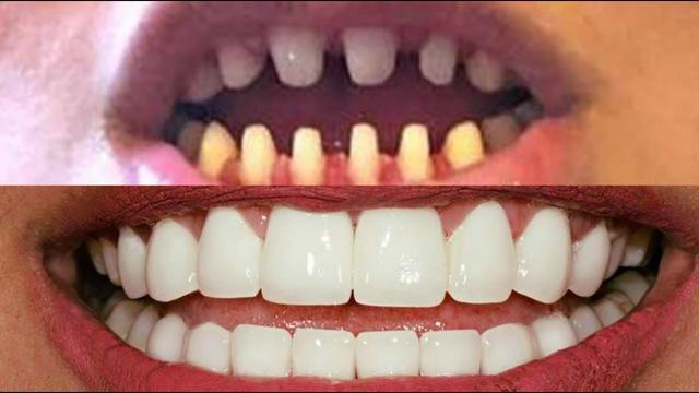 一个牙医的良心忠告：不要随便做烤瓷牙