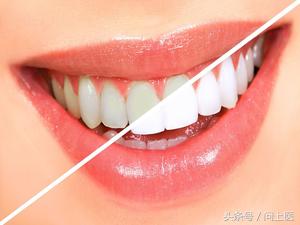 牙齿美白实用小技巧：拥有明星般的一口白牙不再是梦！
