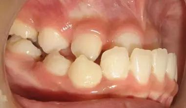 12岁前必须处理的20种儿童牙颌畸形