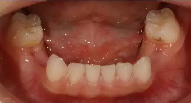 12岁前应该处理的20种儿童牙颌畸形