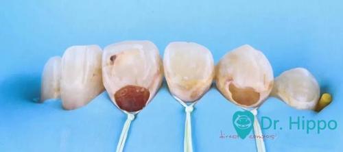 牙齿缺损如何修复？