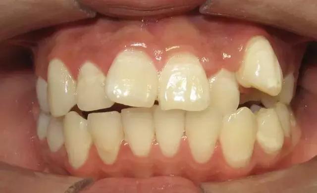 12岁前应该处理的20种儿童牙颌畸形