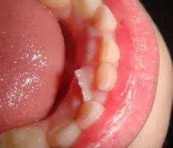 孩子换牙期长出“瓜子牙”，妈妈们得定时给宝宝做口腔检查