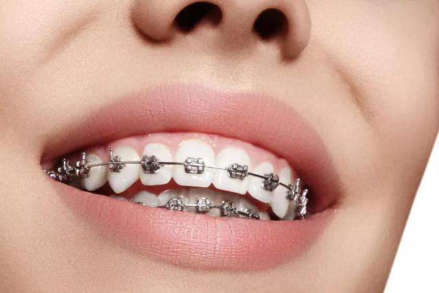 牙齿矫正花多少钱才不算被坑？3千还是3万？