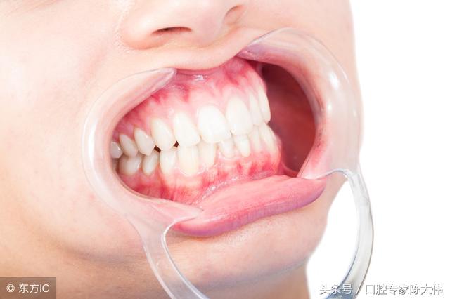 牙龈出血的原因是什么？