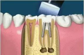 关于牙齿根管治疗你不知道的那些事