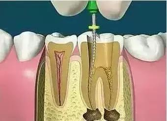关于牙齿根管治疗你不知道的那些事
