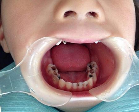宝宝长大龅牙是什么原因造成的？原来是因为这个！